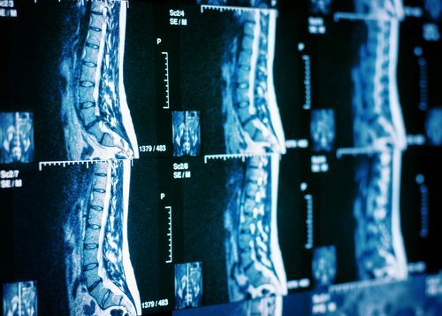 Appalachian Spinal Cord Accident Lawyer