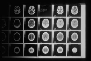 Brain & Spinal Cord East Ellijay