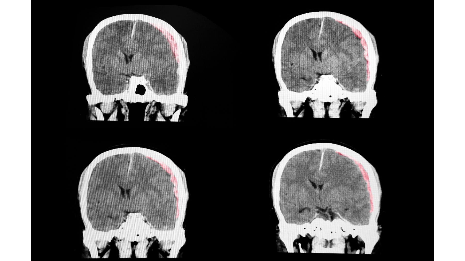 Brain & Spinal Cord Woodstock